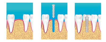 Implant dentaire Paris 16 eme
