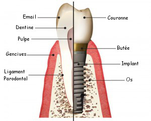 Anatomie Implant
